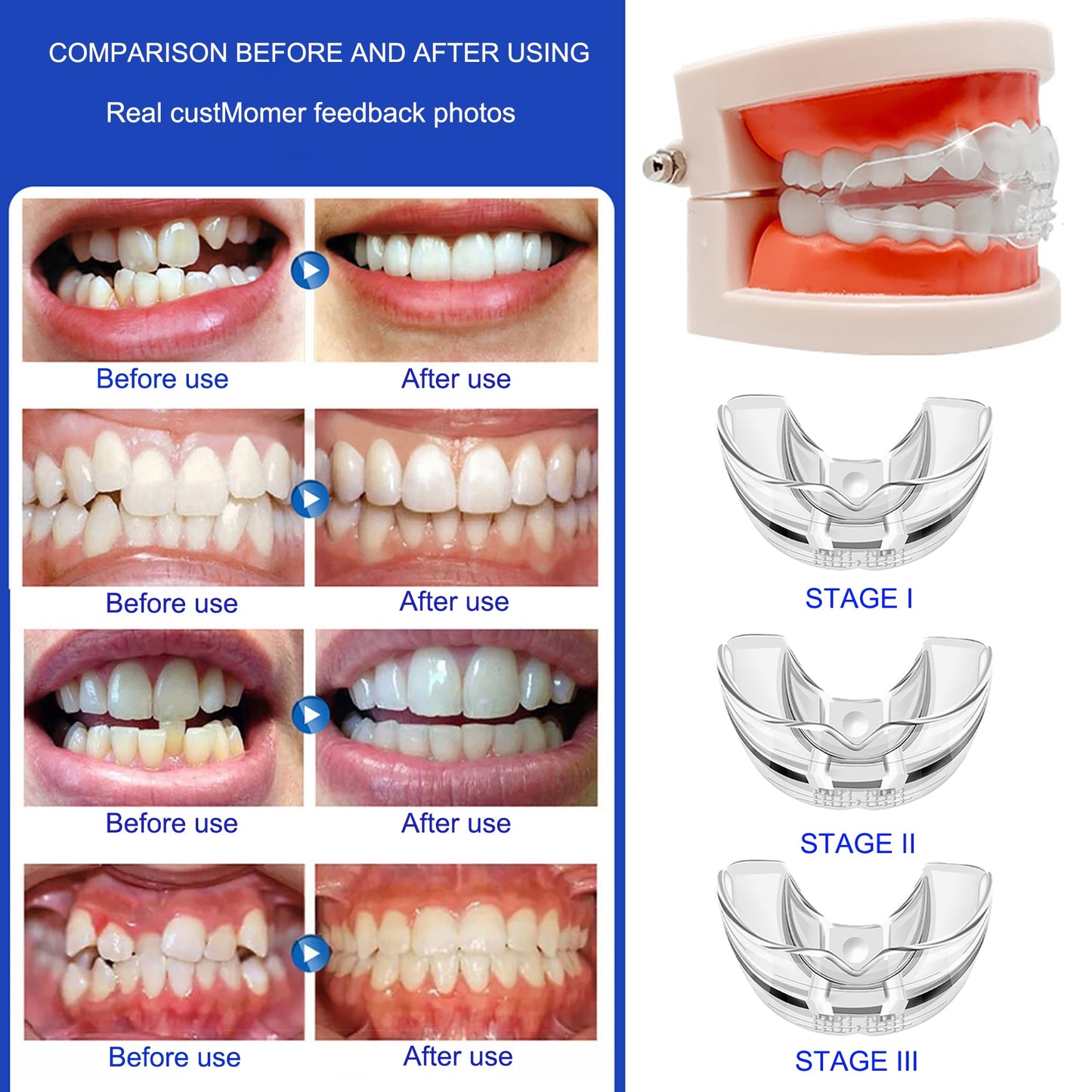 Orthodontic Braces Dental Braces Smile Teeth Alignment Trainer